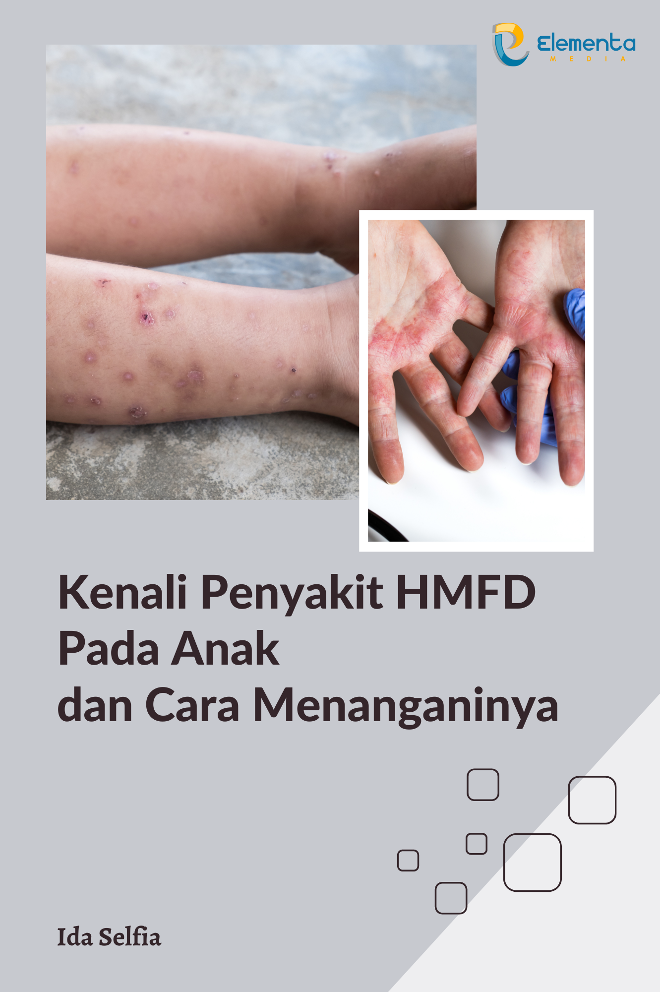 Kenali penyakit HMFD pada anak dan cara menanganinya